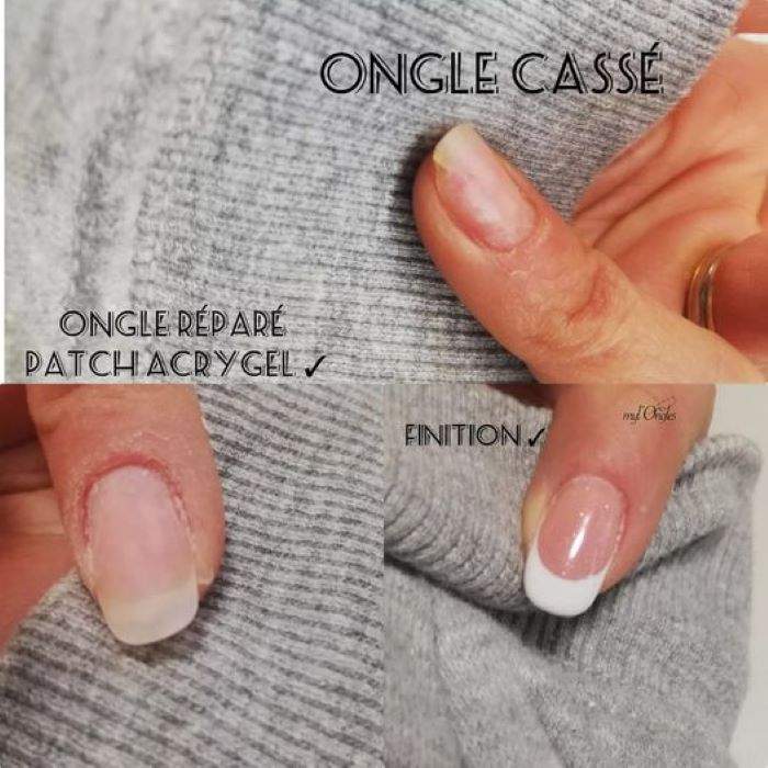 Réparation ongle cassé avec patch acrygel