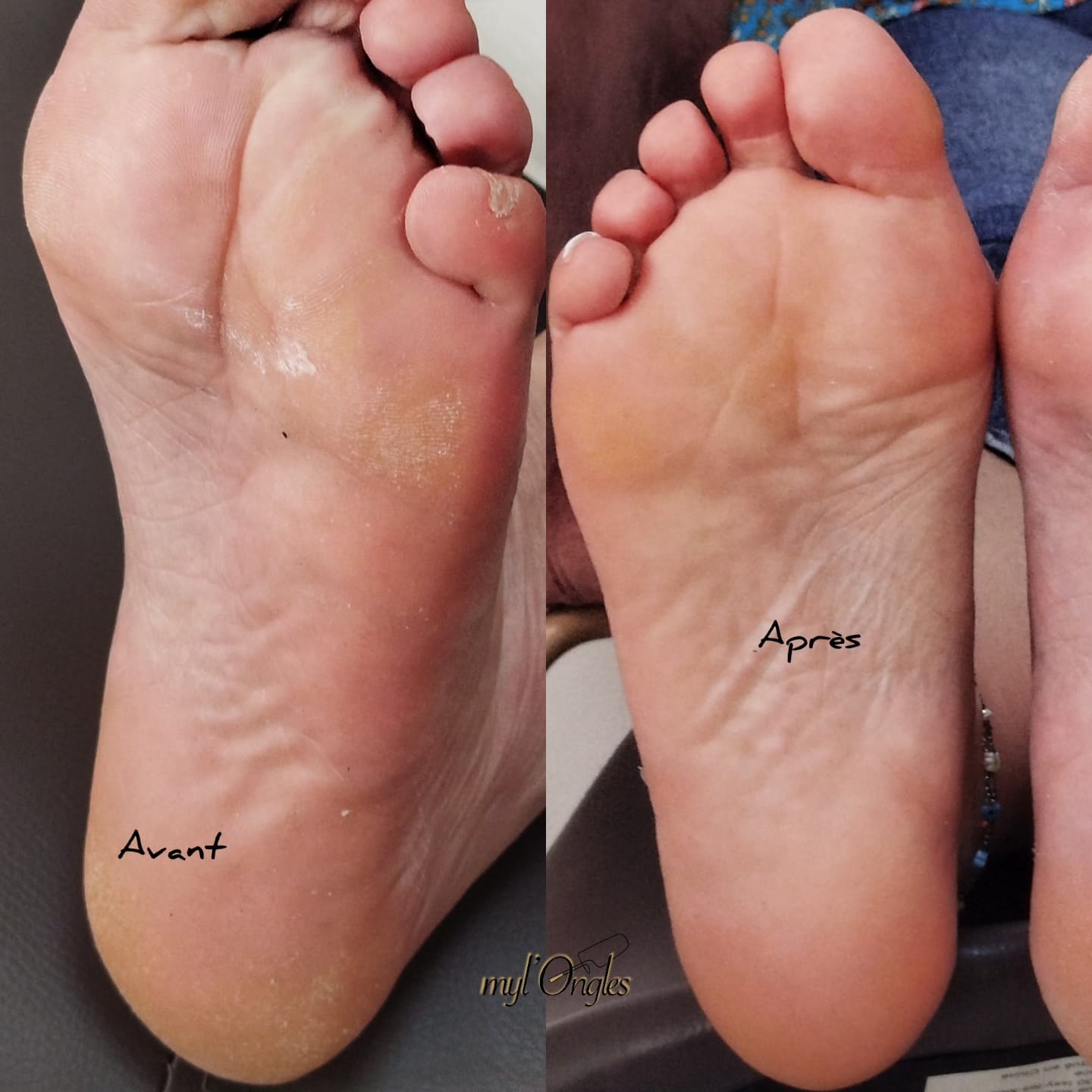 Soin anti-callosités pour adoucir les pieds, gommage, masque